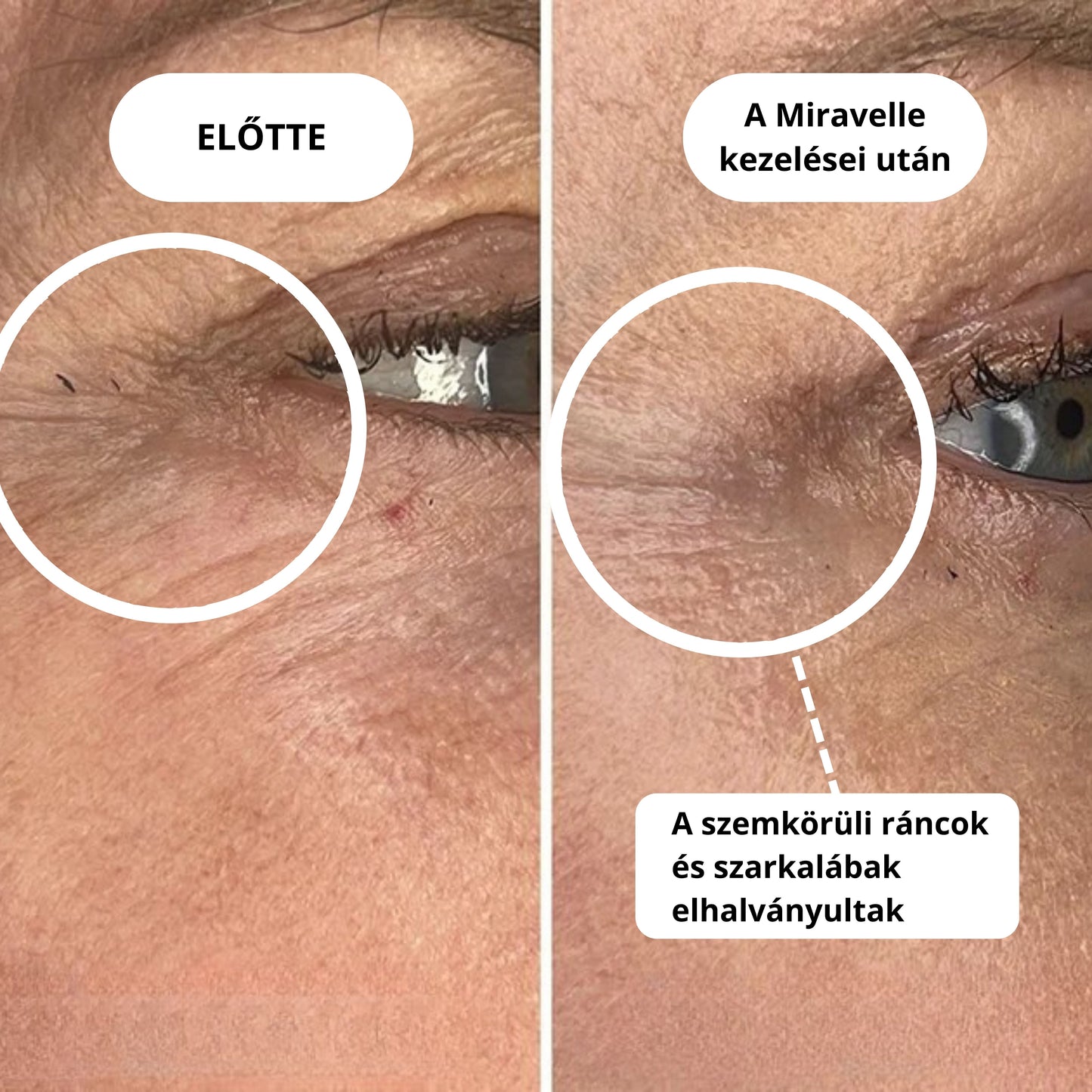 Micro-Infúziós kezelés