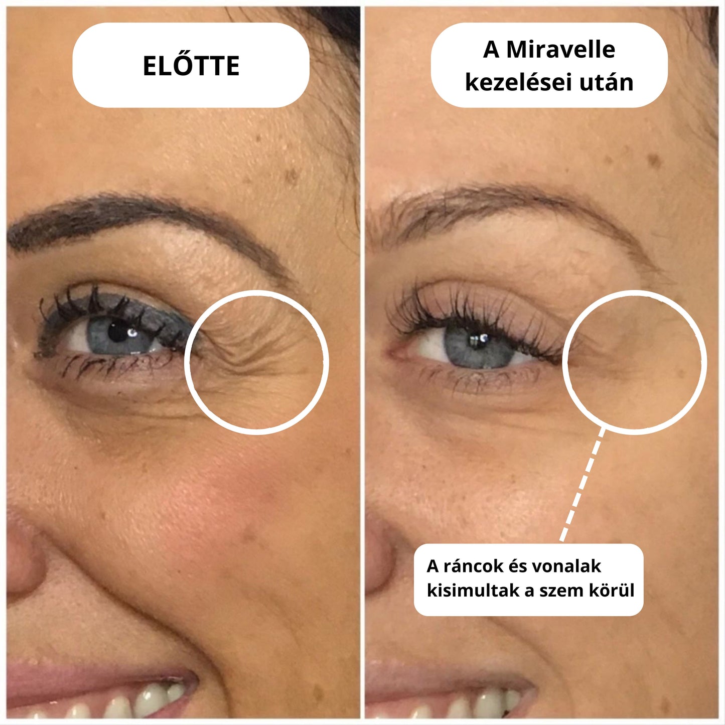 Micro-Infúziós kezelés